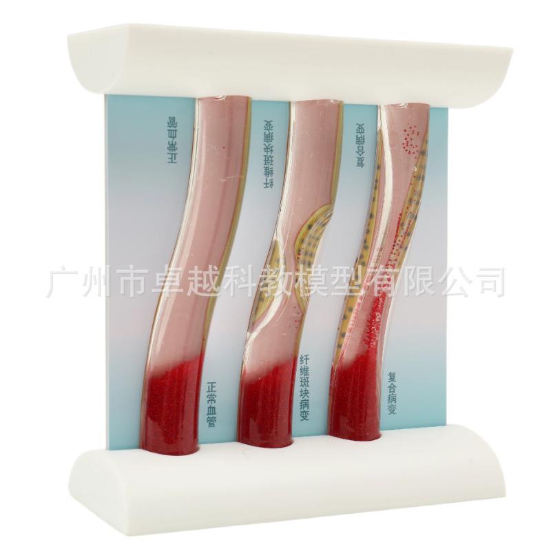动515态高血血管堵对解比模型病态血管脂塞浓稠度对比说血管模型