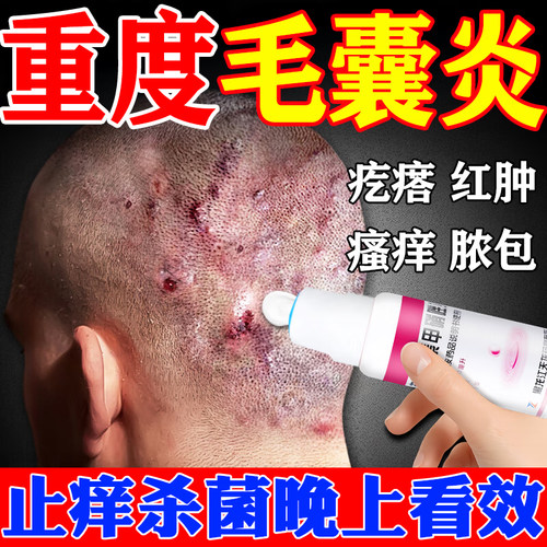 【天龙】克林霉素甲硝唑搽剂0.8%1%*40ml*1瓶/盒治疗毛囊炎特新效抹药