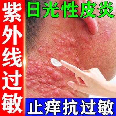 日光性皮炎紫外线过敏皮肤晒伤瘙痒干燥修复止痒日光性皮炎止痒膏