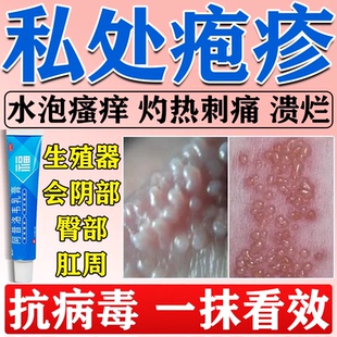 阿昔洛韦软膏乳膏正品生殖器疱疹专用药私处带状疱疹真菌感染瘙痒
