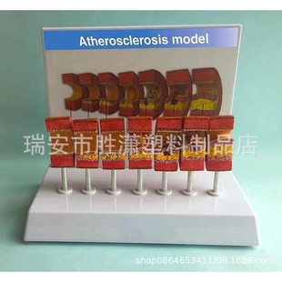 动脉病变硬化模型 血管血栓栓塞模型动脉血管脂血管堵塞病态血管