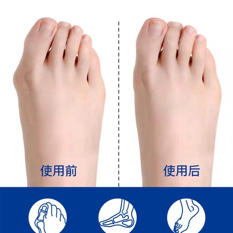 科靓拇指外翻脚趾矫正器可调节大护膝/护腰/护肩/护