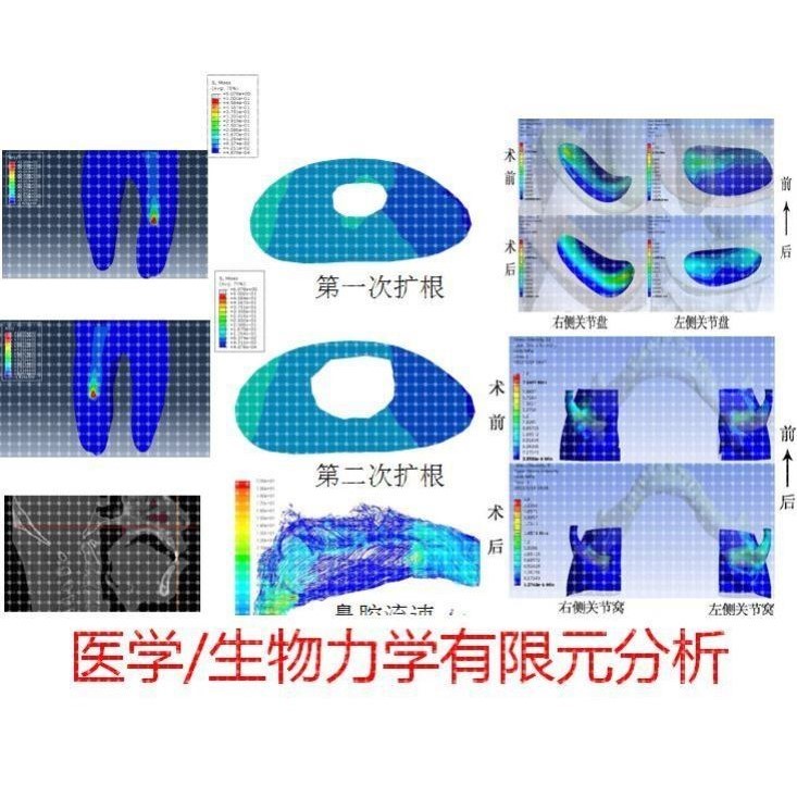 代做/ANSYS/Abaqus/Marc/生物医学工程&生物力学有限元分析