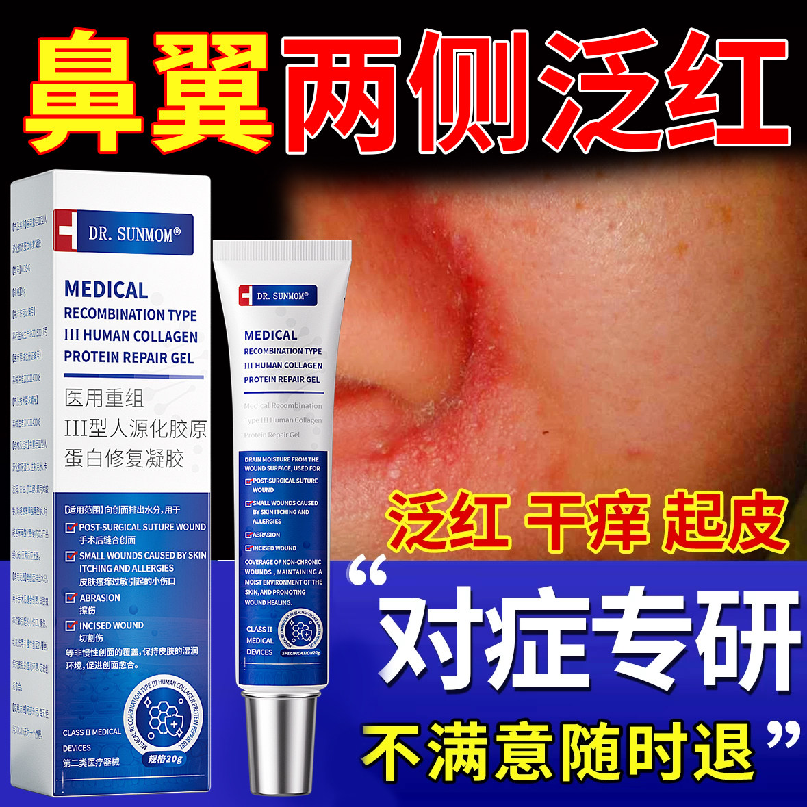鼻子两侧发红脱皮鼻翼两边泛红干燥起皮掉皮酒槽鼻修复脂溢性皮炎