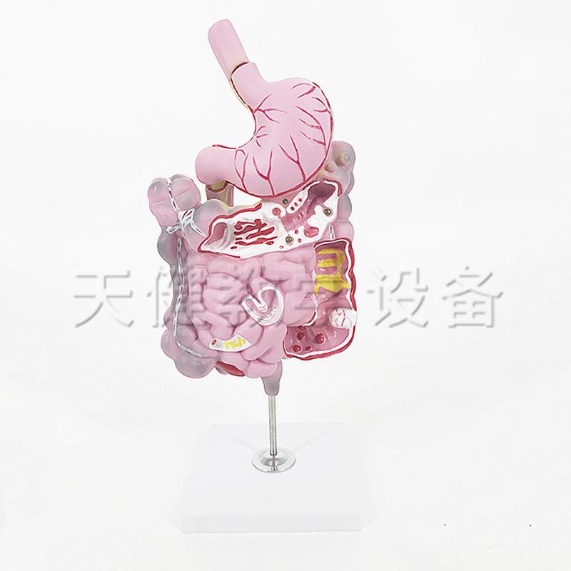 TJ-D013消化系统病变模型人体消化系统病变教学模型