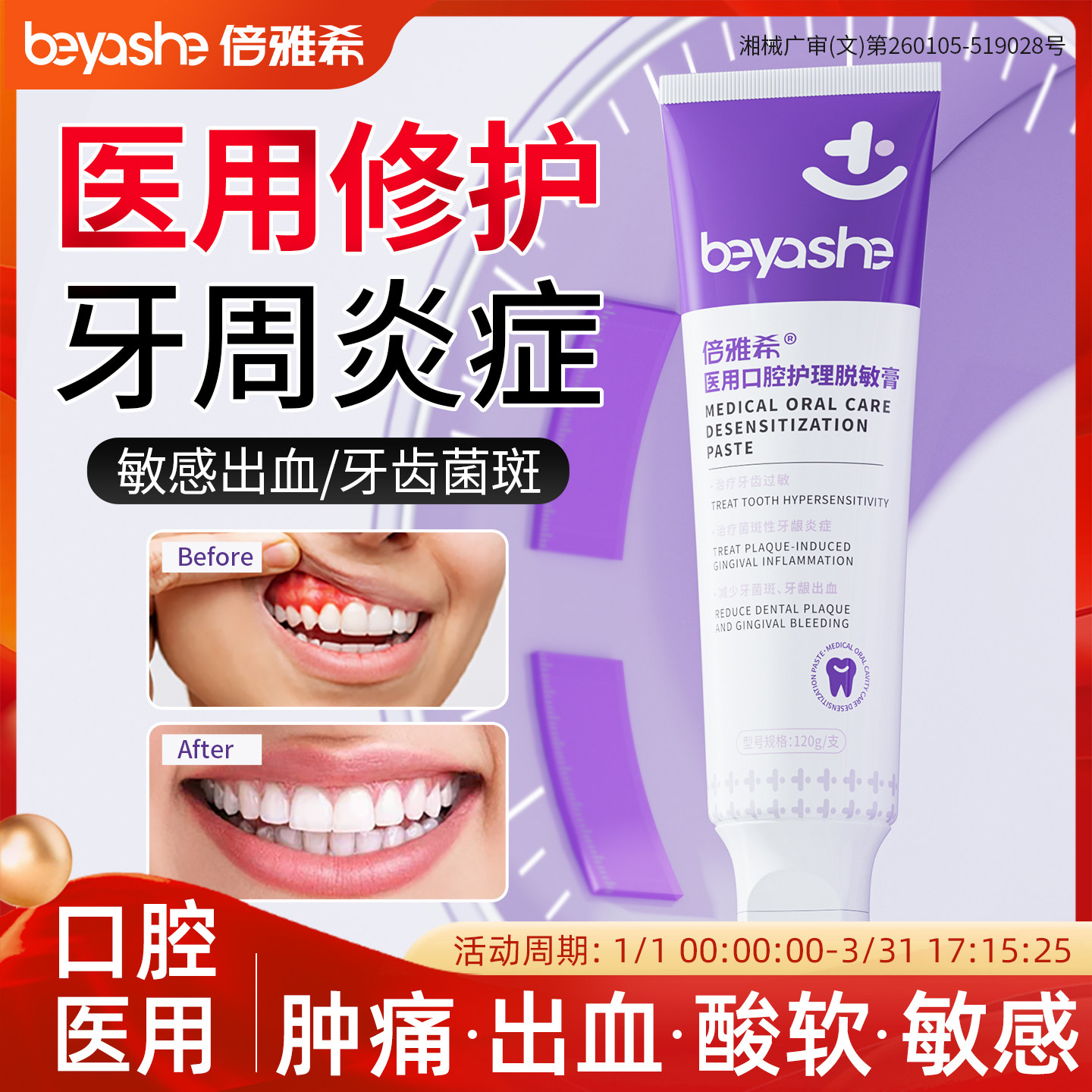 医用牙齿脱敏膏非牙膏牙周炎症专用抗敏修复护龈固齿牙龈出血萎缩,医疗器械,牙齿防龋/脱敏类,淘宝优惠券,粉丝福利购,淘宝优惠卷