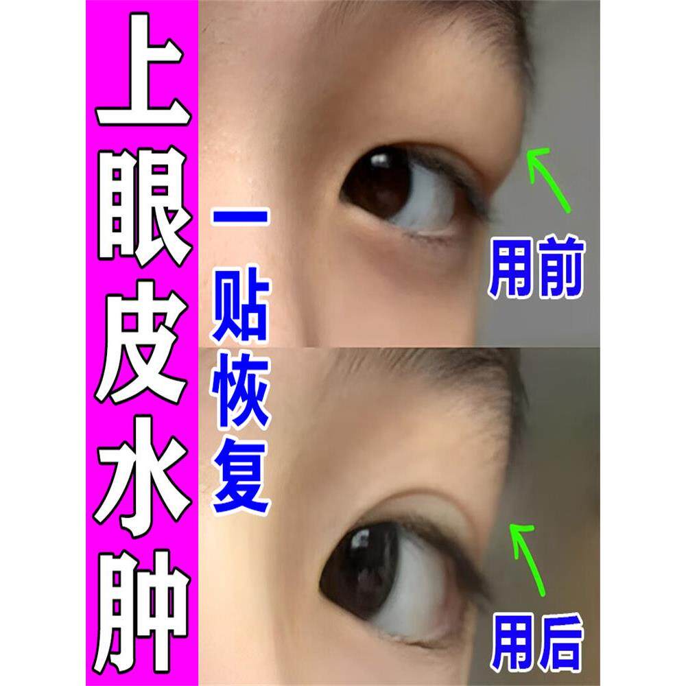 眼肿泡，鱼泡，眼皮肿，去肿，去水肿，一个特殊的眼罩熬夜红，肿