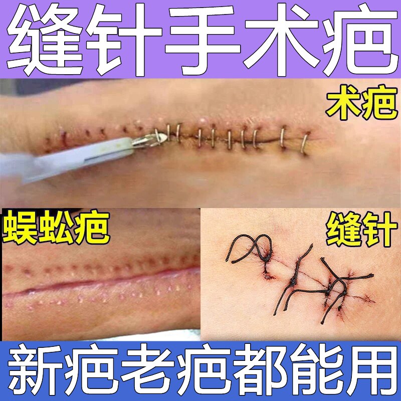 消疤克星祛疤膏去疤痕修复膏手术剖腹产烫伤除疤巴官方旗舰店正品