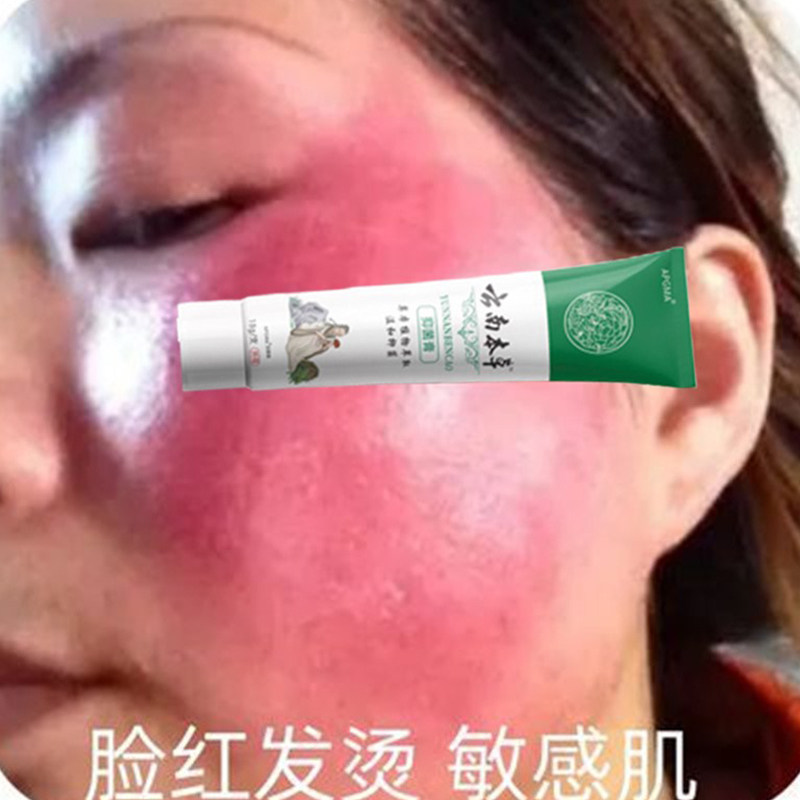 红脸蛋褪红脸过敏脸大红脸敏感肌乳液/面霜