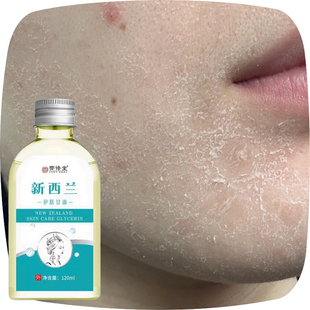 脸太干脱皮脸上起皮干燥脸干痒面部爆皮掉皮屑皮肤起干皮粗糙卡粉