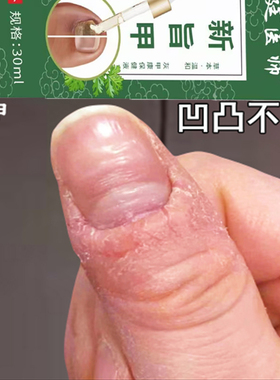 手指甲竖纹手指甲真菌感染手指指甲盖有黑色竖纹黑线手指甲护理膏