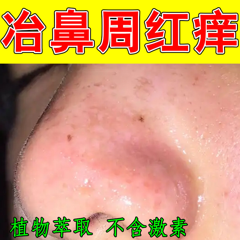 冶鼻周红痒干燥起皮脱屑痒外用草皮肤消毒护理（消）