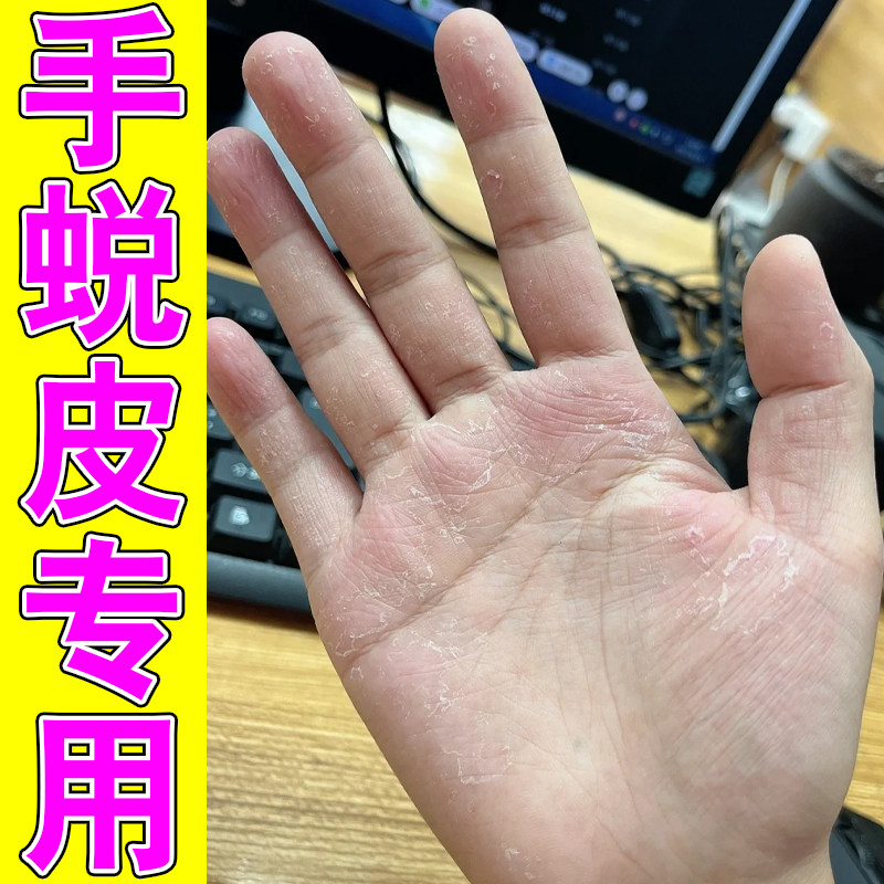 手足脱皮膏护肤膏手指上起皮干燥皮肤消毒护理（消）
