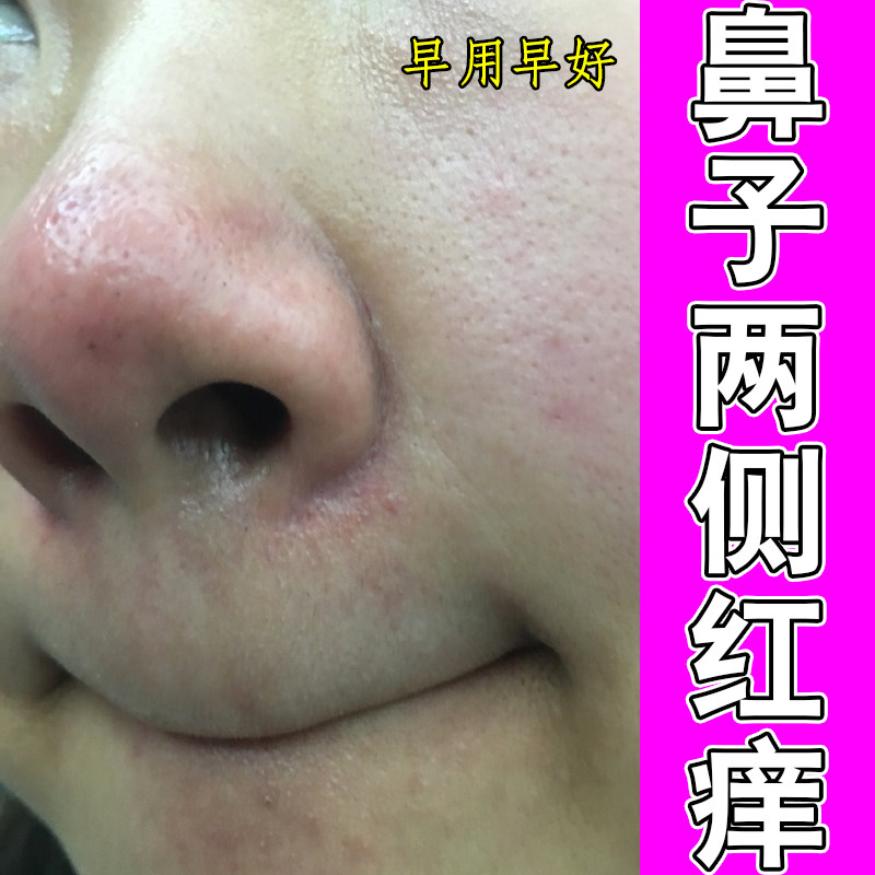 鼻子两侧红痒起皮干燥脱屑酒糟鼻皮肤消毒护理（消）