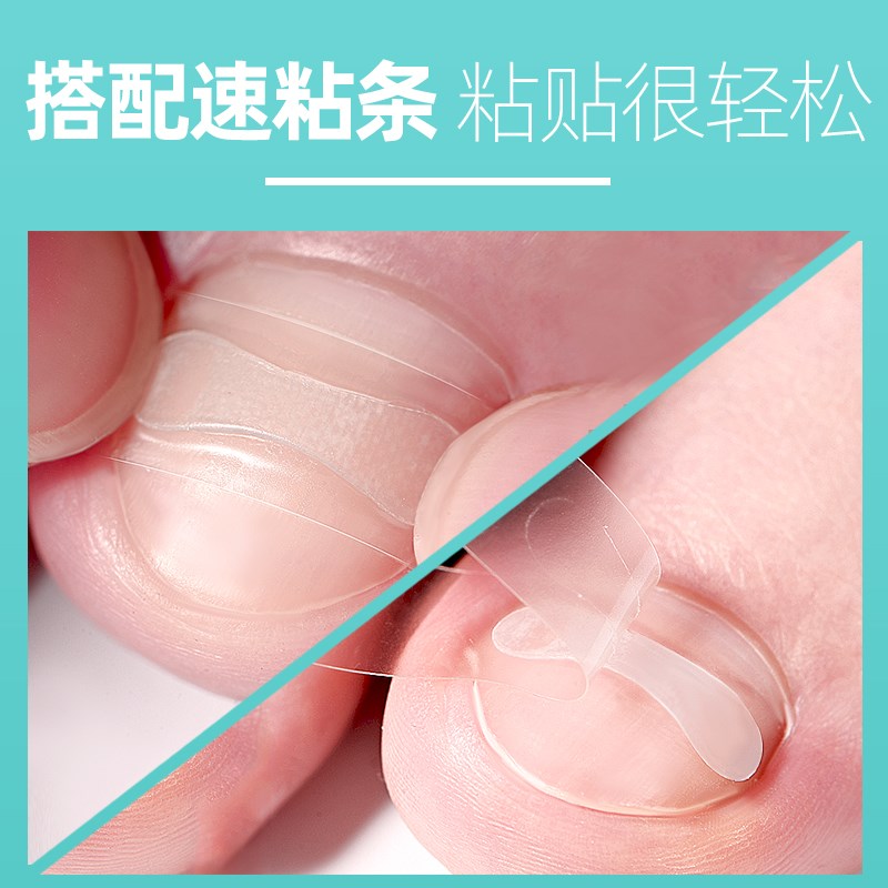 脚医生甲沟嵌甲矫正器炎正甲贴脚趾指甲往肉里长贴片指甲刀剪