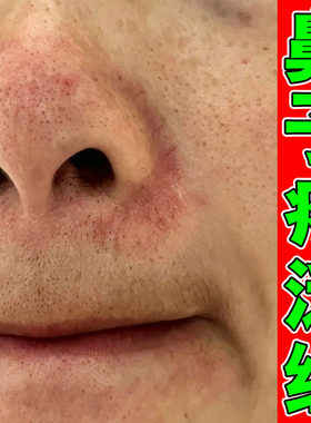 鼻子边发红鼻翼两边泛红起皮掉皮酒槽鼻修复脂溢性油腻鼻