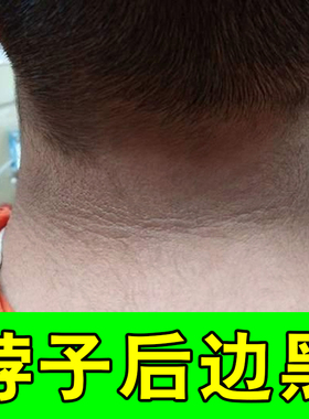 去脖颈黑黑的洗不干净黑色素沉淀洗不干净专用