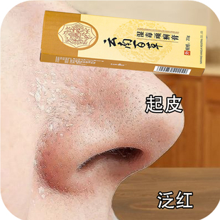鼻子两侧发红起皮掉皮屑鼻子干翼两边起皮酒糟鼻