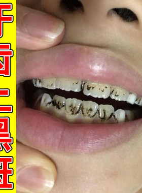 牙齿内侧黑色污垢牙上咖啡渍茶渍牙黄牙黑用