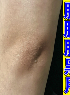去手肘黑色素沉淀胳膊肘去黑去死皮肤黑色素沉淀