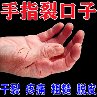 手干燥粗糙手裂药的膏防手指脚后跟龟裂冬天手开裂口子护手霜