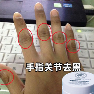 手指关节黑外用手指泛黑黑色素沉淀脖子腋窝四肢关节发黑