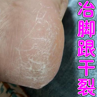 专冶脚后跟干裂的药足跟起硬皮脚底干燥粗糙开裂掉皮屑膏