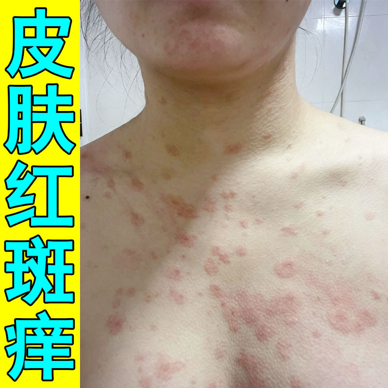 季节性玫瑰糠红斑专用膏胸口皮肤皮肤消毒护理（消）