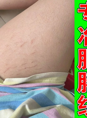 生长纹肥胖纹去大腿内侧纹身上红纹白纹男女专用淡纹修复膏