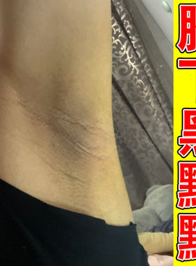 腋窝黑色素沉淀去黑腋窝除黑色素胳肢窝黑黑的修复