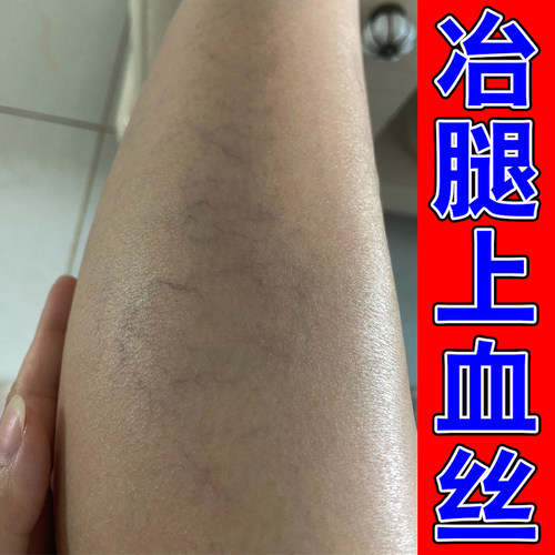 身上起红点皮下长小红点小腿长小红血丝毛细血管扩张肿胀