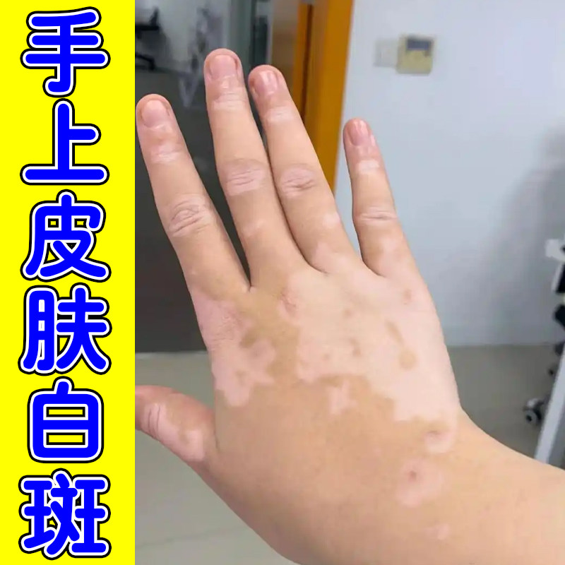 手背皮肤长白斑促进黑色素生长补骨脂酊手上肤色不均有白色斑点