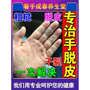 治疗手脱皮的药膏手指上起皮干燥脚粗糙掉皮足底真菌感染皮肤裂开