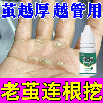 手上茧子手指手掌起老茧