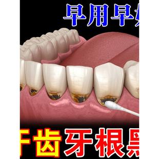 牙根发黑牙垢牙菌斑牙烟渍牙斑净牙缝发黑清理神器牙齿黑氟斑牙药