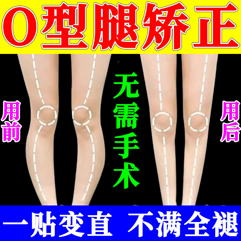 o型腿矫正神器小腿外翻儿