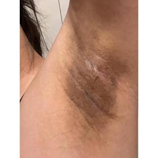 腋下变白去黑色素沉淀去除内分泌失调腋窝黑脖子黑棘皮症洗不干净
