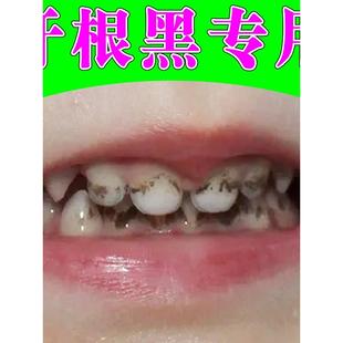 牙斑净去牙缝发黑清理神器牙根黑黑的去除牙结石牙垢口臭牙齿发黑