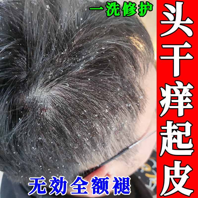 头皮干燥起补水去屑止痒