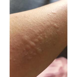 身上痒起红疙瘩换季皮肤长小红点痘痘痒专冶荨麻过敏外用的药软膏