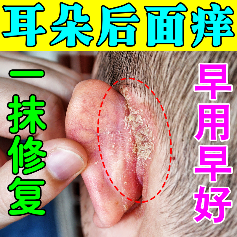 耳朵发痒药后面干燥起皮