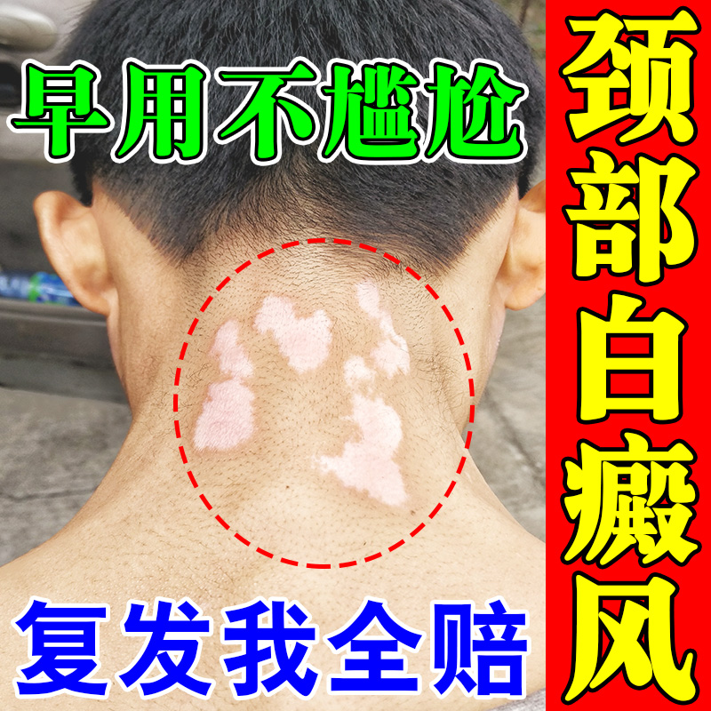脖子白癜风药膏快速消白