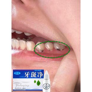 牙斑净去牙缝发黑清理神器牙菌斑牙根黢黑祛除黄牙齿烟渍茶渍黑渍