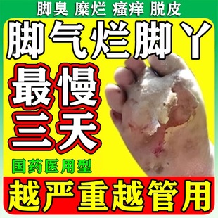 达克宁盐酸特比萘芬乳喷剂膏治脚气脱皮水泡脱皮烂脚丫杀菌止痒