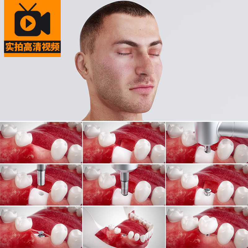 牙科植入拔牙补牙镶牙种植牙齿镶假牙修复治疗3D动画演示视频素材