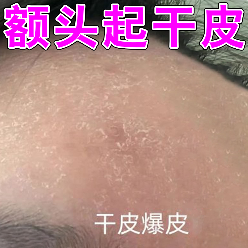 额头起干皮脸上起皮掉皮脱皮掉皮屑脸发痒泛红面部干痒皮肤粗糙干