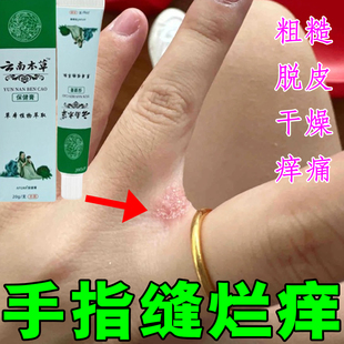 手指缝溃烂药膏烂手丫专用霜手指间红肿开裂发红脱皮痒长时间泡水