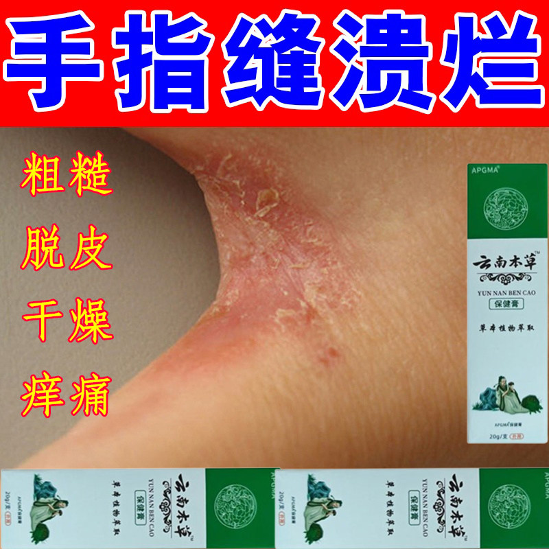 烂手丫专用膏药手指缝溃烂药手气干痒脱皮杀菌去痒专用膏真菌感染