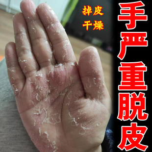 手脱皮严重脱皮专用季节性手指尖手心手掌手脚掉皮破皮褪皮爆皮痒