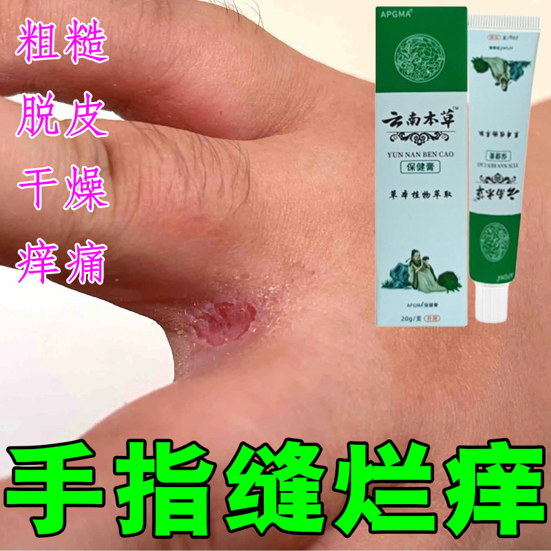 手指缝溃烂痒经常碰水脱皮长水泡发红干裂口干痒手起烂手丫专用乳